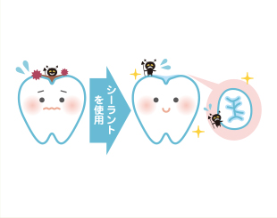シーラント処置