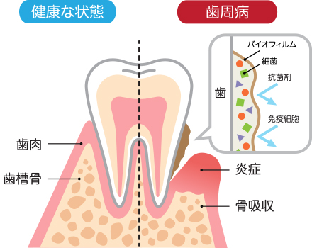 「歯周病」とは